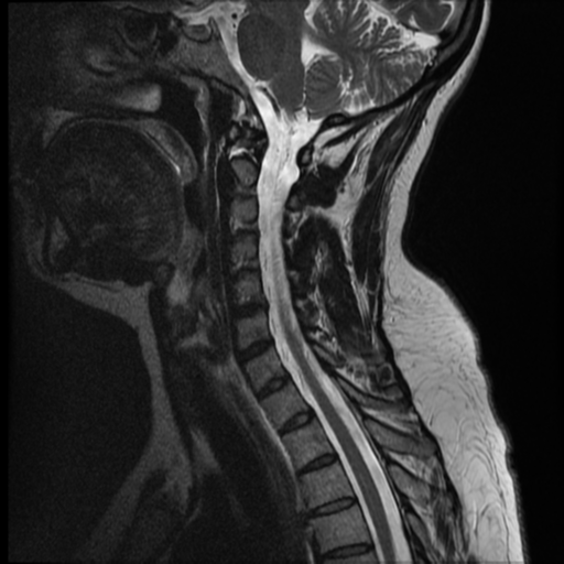 File:Normal cervical and thoracic spine MRI (Radiopaedia 35630-37156 Sagittal T2 8).png