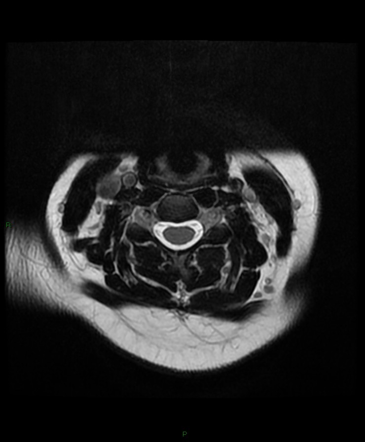 Normal cervical spine MRI (Radiopaedia 80146-93454 Axial T2 40).jpg