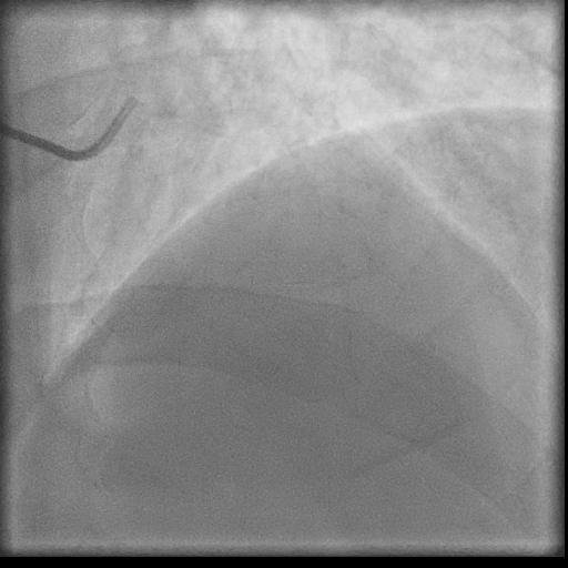 Normal coronary angiogram (DSA) (Radiopaedia 63081-71571 E 5).jpg