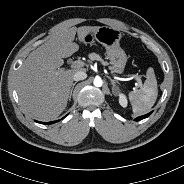 Normal kidneys on 4-phase CT study (Radiopaedia 25889-26038 B 4).jpg