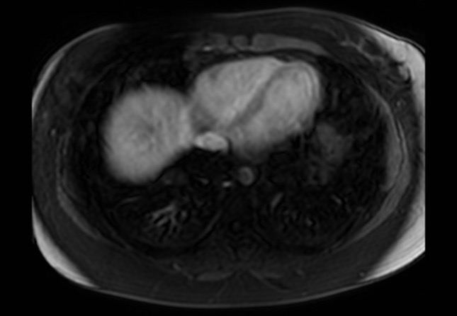 Normal liver MRI with Gadolinium (Radiopaedia 58913-66163 J 73).jpg