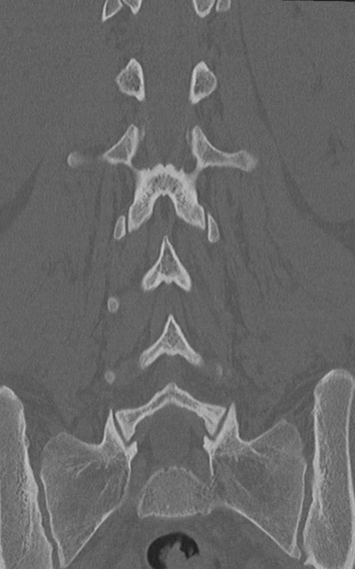 Normal lumbar spine CT (Radiopaedia 46533-50986 Coronal bone window 49).png