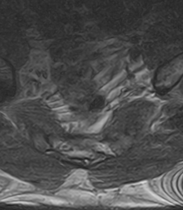 Normal lumbar spine MRI - low-field MRI scanner (Radiopaedia 40976-43699 Axial T2 104).jpg