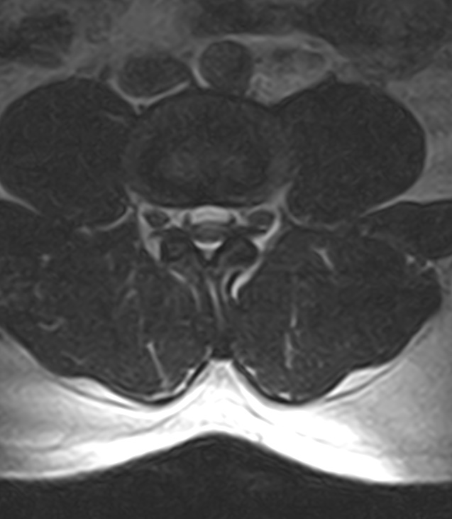 Normal lumbar spine MRI - low-field MRI scanner (Radiopaedia 40976-43699 Axial T2 59).jpg
