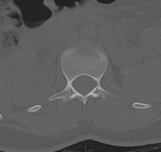 File:Normal lumbosacral CT (Radiopaedia 37923-39867 Axial bone window 32).png