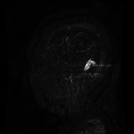 Normal noncontrast MR venography (Radiopaedia 87578-103957 A 16).jpg
