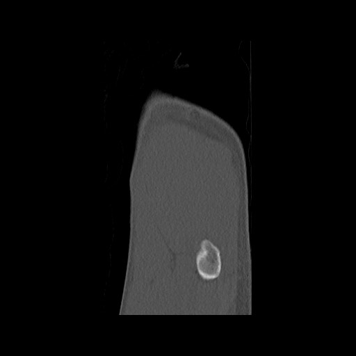 Normal pelvis (Radiopaedia 51473-57238 Sagittal bone window 6).jpg