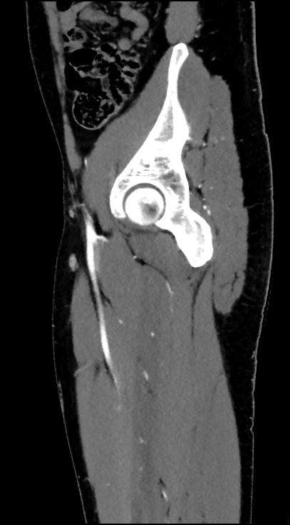 Normal pelvis CT angiogram (Radiopaedia 84966-100481 C 31).jpg