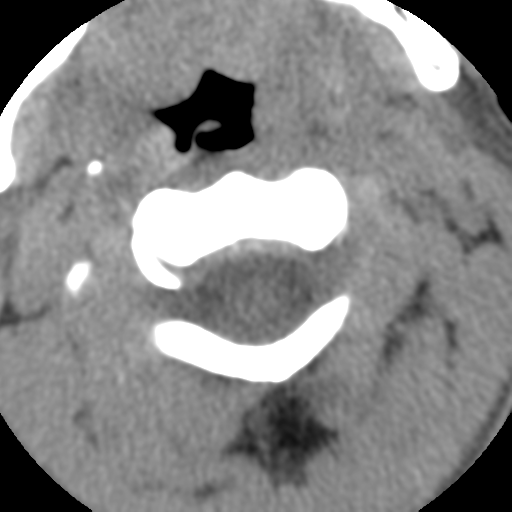 Normal trauma cervical spine (Radiopaedia 41017-43760 Axial non-contrast 17).png