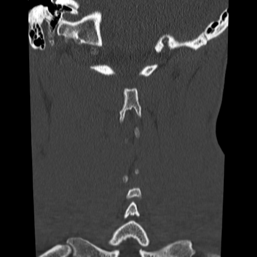 File:Normal trauma cervical spine (Radiopaedia 41017-43760 Coronal bone window 34).png