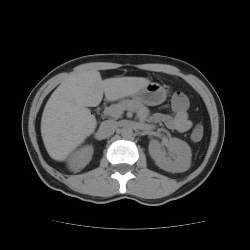 File:Obstructed kidney with perinephric urinoma (Radiopaedia 26889-27067 Axial non-contrast 2).jpg