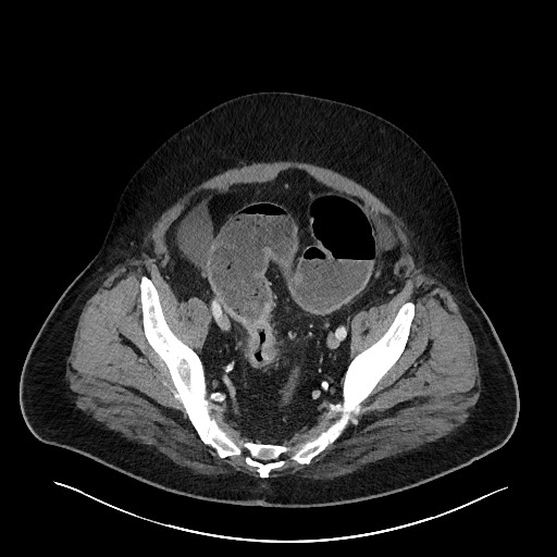 File:Obstructing sigmoid adenocarcinoma (Radiopaedia 58465-65619 A 135).jpg