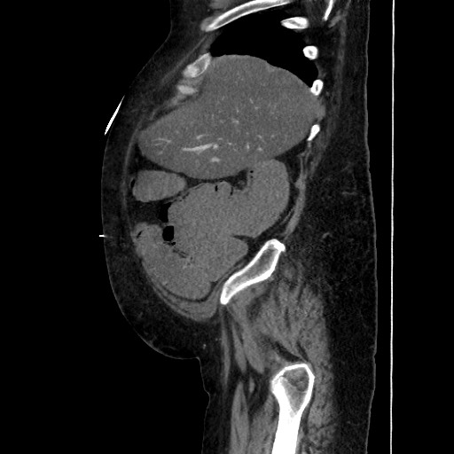 Obstructive colonic diverticular stricture (Radiopaedia 81085-94675 C 54).jpg