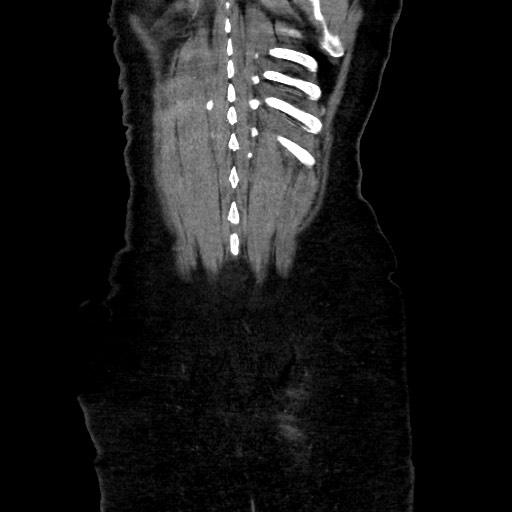Obstructive distal colonic adenocarcinoma causing cecal perforation (Radiopaedia 86830-102989 C 152).jpg