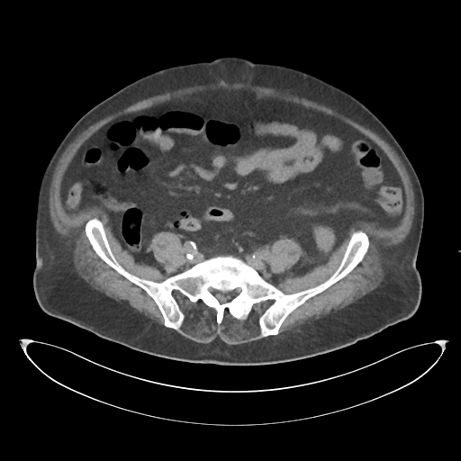 File:Obstructive pyelonephritis (Radiopaedia 46411-50844 Axial non-contrast 55).png