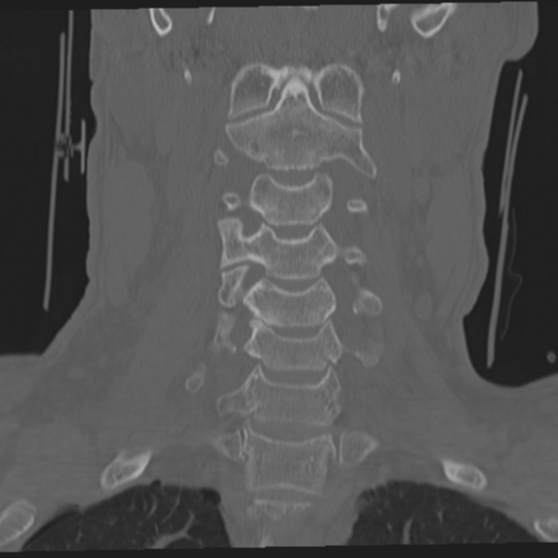 File:Occipital condyle fracture (Radiopaedia 33467-34517 Coronal bone window 27).png