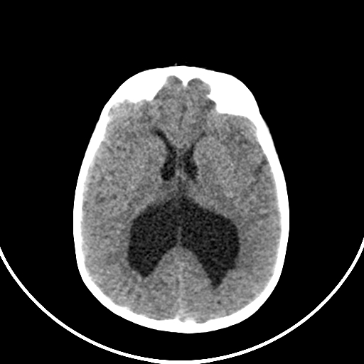 Occipital encephalocele (Radiopaedia 87339-103636 Axial non-contrast 47).jpg