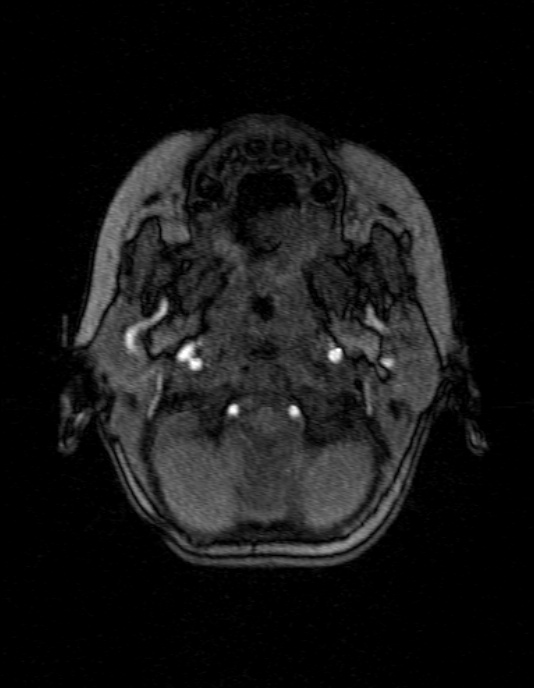 Occipital horn syndrome (Radiopaedia 14255-14129 MRA 14).jpg