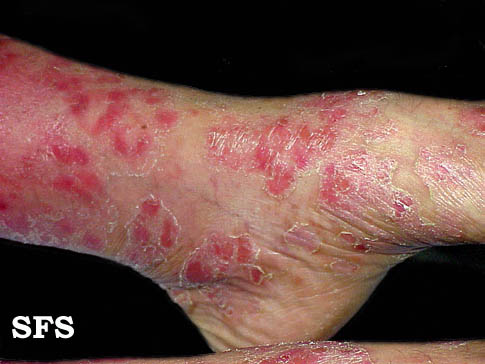 File:Psoriasis (Dermatology Atlas 3).jpg
