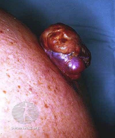 File:Ulcerated nodular melanoma (DermNet NZ lesions-mel3).jpg