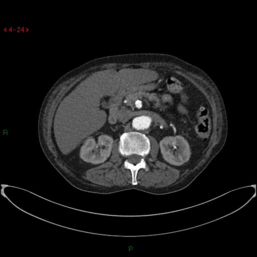 File:Abdominal aortic aneurysm (Radiopaedia 16155-15834 Axial C+ arterial phase 4).jpg
