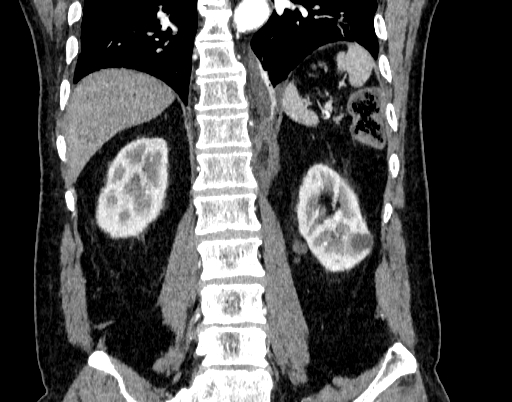 Abdominal aortic aneurysm (Radiopaedia 67117-76452 Coronal C+ arterial phase 76).jpg