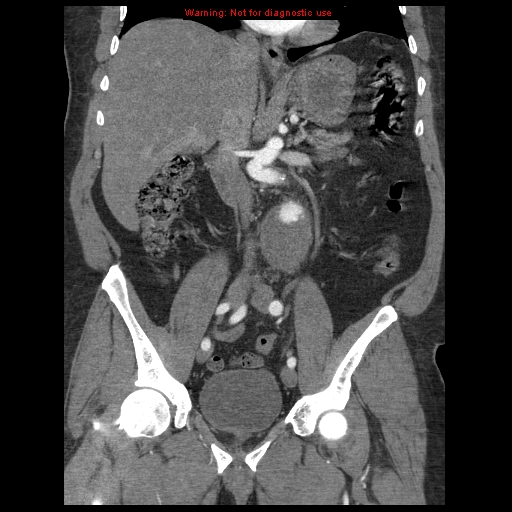 File:Abdominal aortic aneurysm (Radiopaedia 8190-9038 Coronal C+ arterial phase 66).jpg