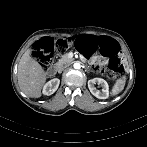 Abdominal aortic aneurysm (Radiopaedia 83581-98689 Axial C+ arterial phase 45).jpg