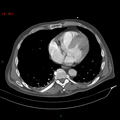 Abdominal aortic aneurysm rupture with aortocaval fistula (Radiopaedia 14897-14841 Axial C+ arterial phase 49).jpg