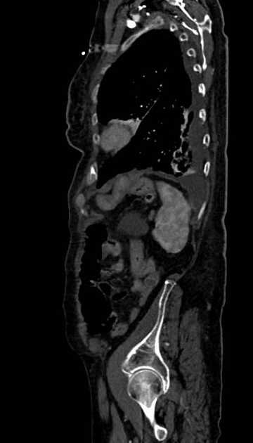 Abdominal aortic aneurysm with thrombus fissuration (Radiopaedia 73192-83919 Sagittal C+ arterial phase 20).jpg