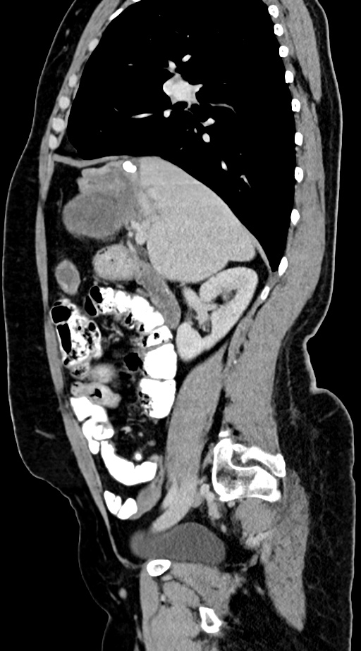 Abdominal hydatid disease (Radiopaedia 68223-77737 Sagittal C+ portal venous phase 46).jpg