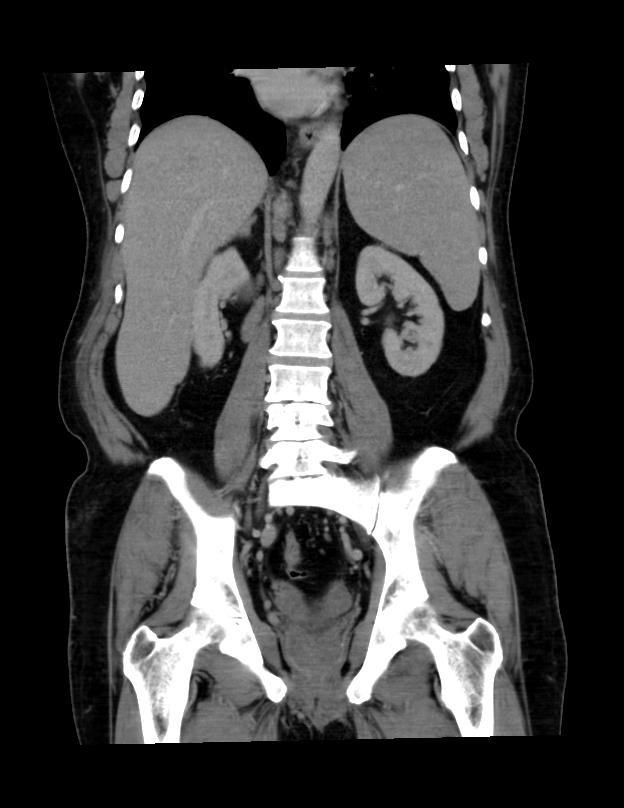 Abdominal lymphoma - with sandwich sign (Radiopaedia 53486-59492 C+ portal venous phase 21).jpg