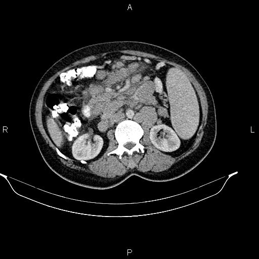 File:Abdominal lymphoma with sandwich sign (Radiopaedia 84378-99704 Axial C+ portal venous phase 26).jpg