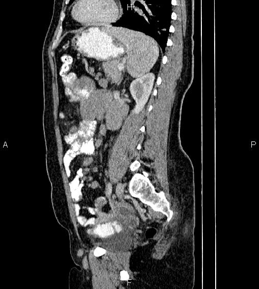 File:Abdominal lymphoma with sandwich sign (Radiopaedia 84378-99704 Sagittal C+ portal venous phase 60).jpg
