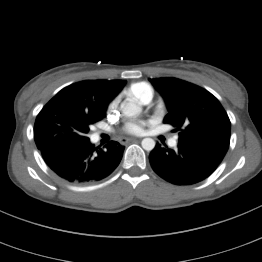 File:Abdominal multi-trauma - devascularised kidney and liver, spleen and pancreatic lacerations (Radiopaedia 34984-36486 Axial C+ arterial phase 42).png