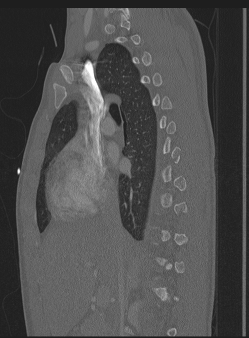 Abdominal multi-trauma - devascularised kidney and liver, spleen and pancreatic lacerations (Radiopaedia 34984-36486 Sagittal bone window 47).png