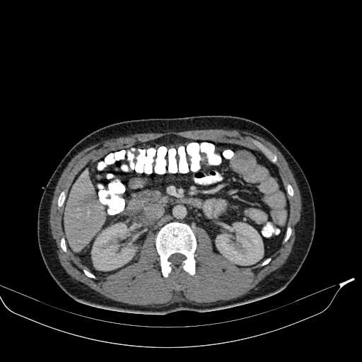 Abdominal multiorgan trauma (Radiopaedia 21792-21754 Axial C+ portal venous phase 21).jpg