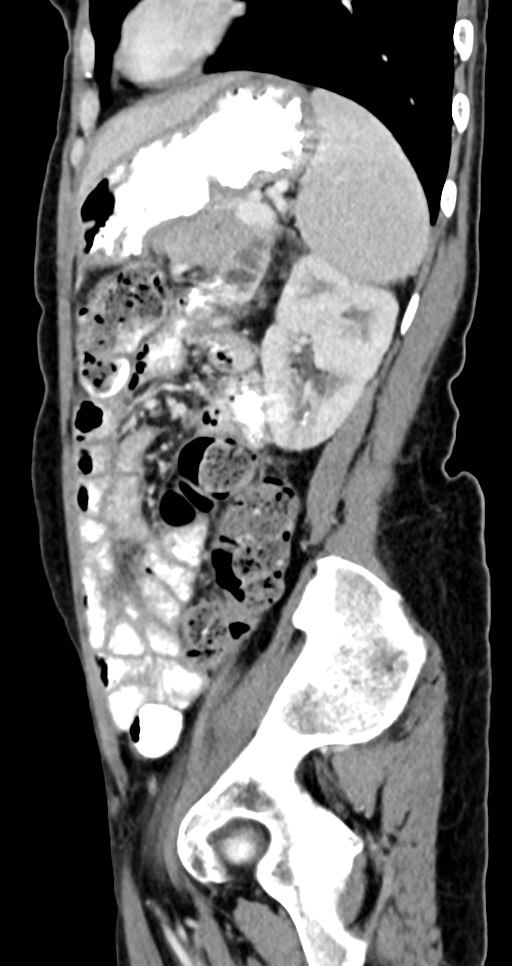 Abdominal wall and retroperitoneal tuberculosis (Radiopaedia 88137-104729 Sagittal C+ portal venous phase 47).jpg