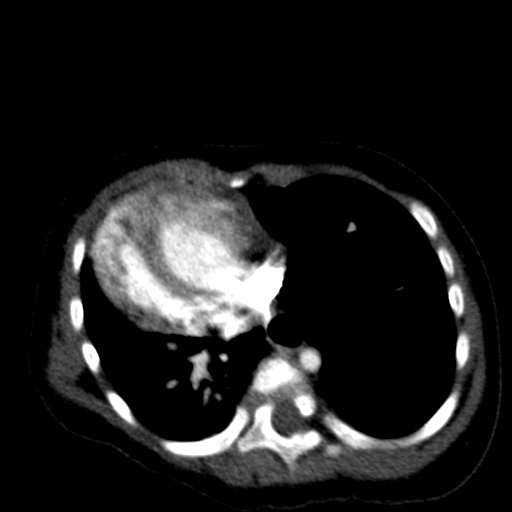 Aberrant left pulmonary artery (pulmonary sling) (Radiopaedia 42323-45435 Axial C+ CTPA 31).jpg