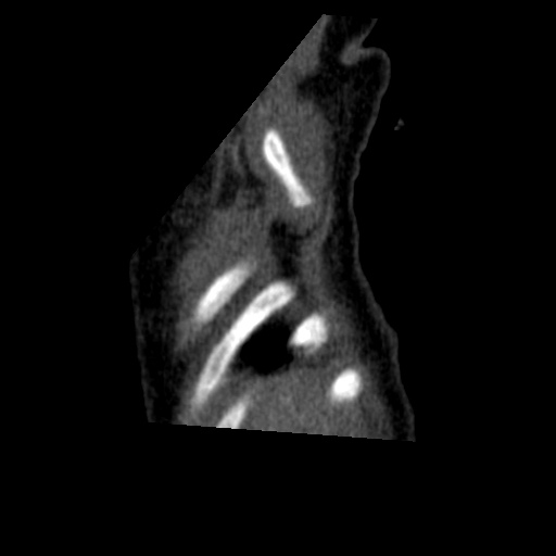 Aberrant left pulmonary artery (pulmonary sling) (Radiopaedia 42323-45435 Sagittal C+ arterial phase 1).jpg