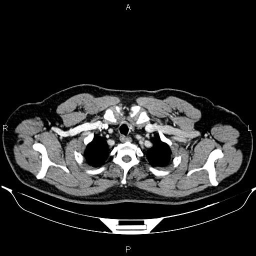 File:Aberrant right subclavian artery (Radiopaedia 87093-103354 Axial With contrast 14).jpg