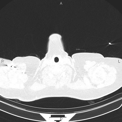 File:Aberrant right subclavian artery (Radiopaedia 87334-103629 Axial lung window 1).jpg
