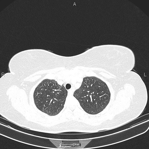 Aberrant right subclavian artery (Radiopaedia 87334-103629 Axial lung window 19).jpg