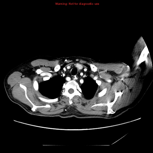 Aberrant right subclavian artery (Radiopaedia 9379-10071 Axial C+ arterial phase 9).jpg
