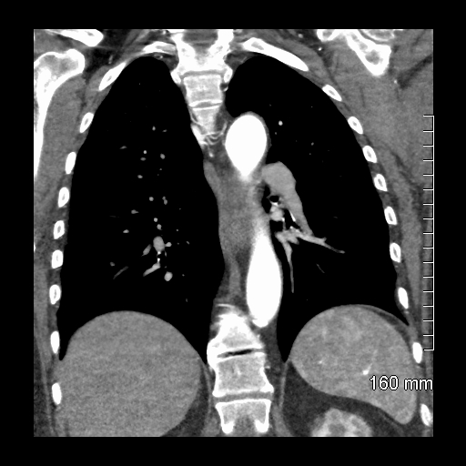Aberrant right subclavian artery stenosis (Radiopaedia 52656-58670 B 58).jpg