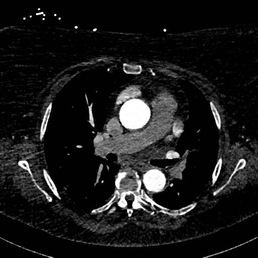 File:Aberrant right subclavian artery with Kommerell diverticulum (Radiopaedia 47982-52769 Axial C+ arterial phase 43).png