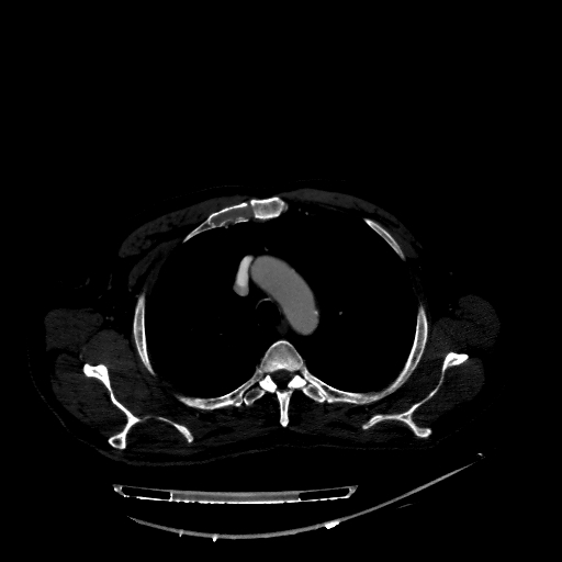 Accesory rib joint (Radiopaedia 71987-82452 Axial bone window 68).jpg