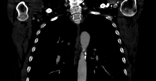 Accesory rib joint (Radiopaedia 71987-82452 Coronal bone window 4).jpg