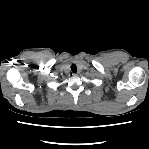 Accessory left horizontal fissure with lingular pneumonia (Radiopaedia 53763-59843 Axial C+ CTPA 7).jpg