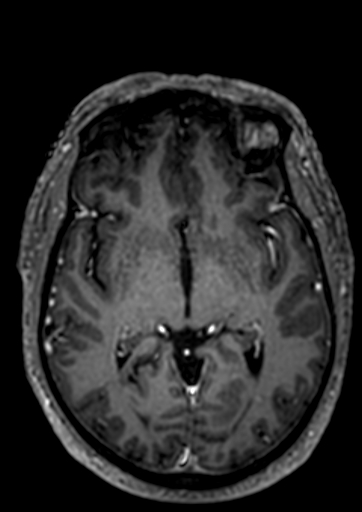 Accessory middle cerebral artery (Radiopaedia 73114-83828 Axial T1 C+ 50).jpg